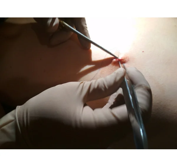 Cyst Removal