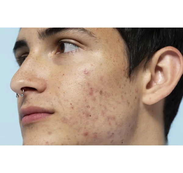 Acne Scars