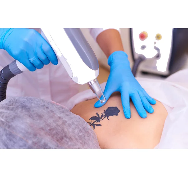 Tattoo Removal