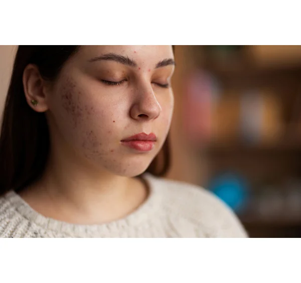 Pigmentation
