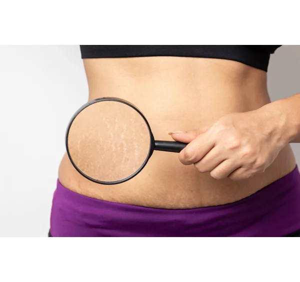 Stretch Marks Treatment