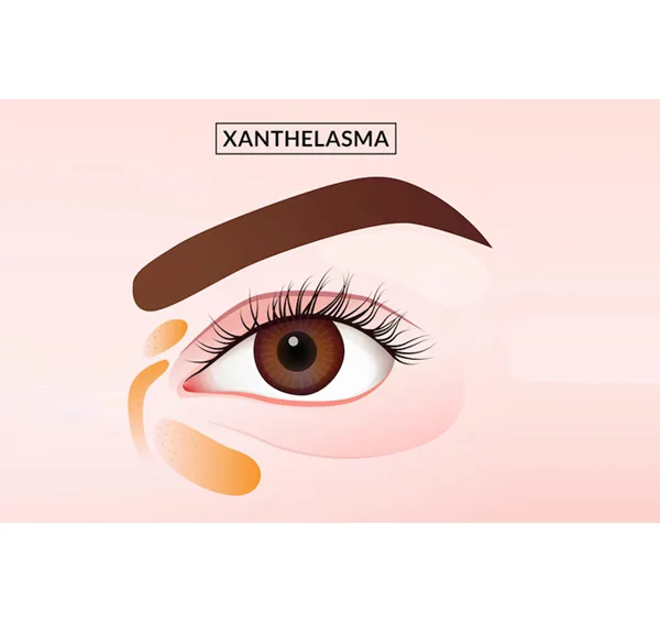 Xanthelasma Treatment