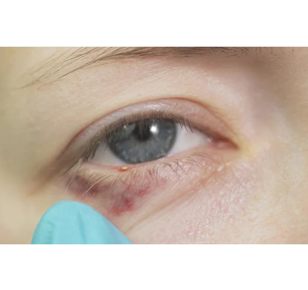 Syringoma Removal