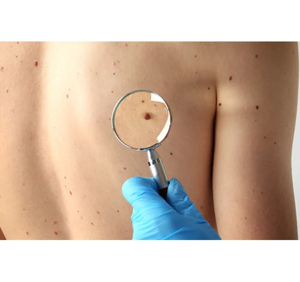 DPN Dermatosis Papulosa Nigra Removal