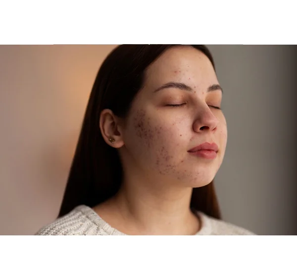 Rosacea Treatment