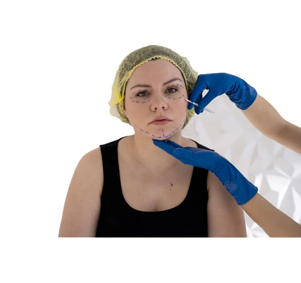 Vampire Facial and Microneedling
